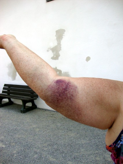Blauer Arm